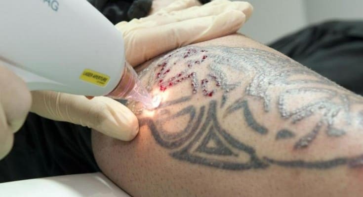Tattoo Removal in Birmingham